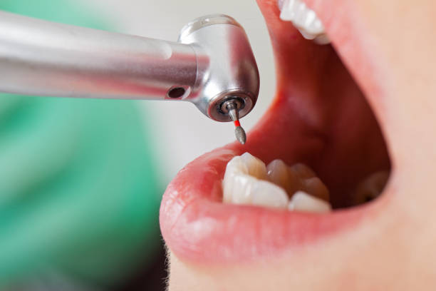 Best Emergency Dental Extractions in Glasgow, MO